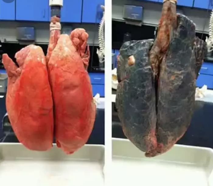 ریه های انسان بعد از ۳۰ سال سیگار کشیدن 